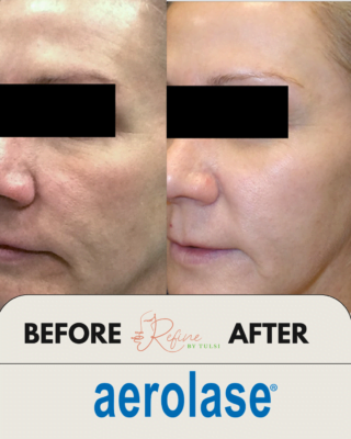 Laser Skin Rejuvenation at Refine by Tulsi Chicago.png