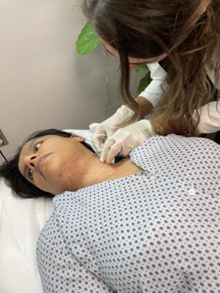 Radiesse Dermal filler patient treatment at Refine by Tulsi to restore volume and youth.