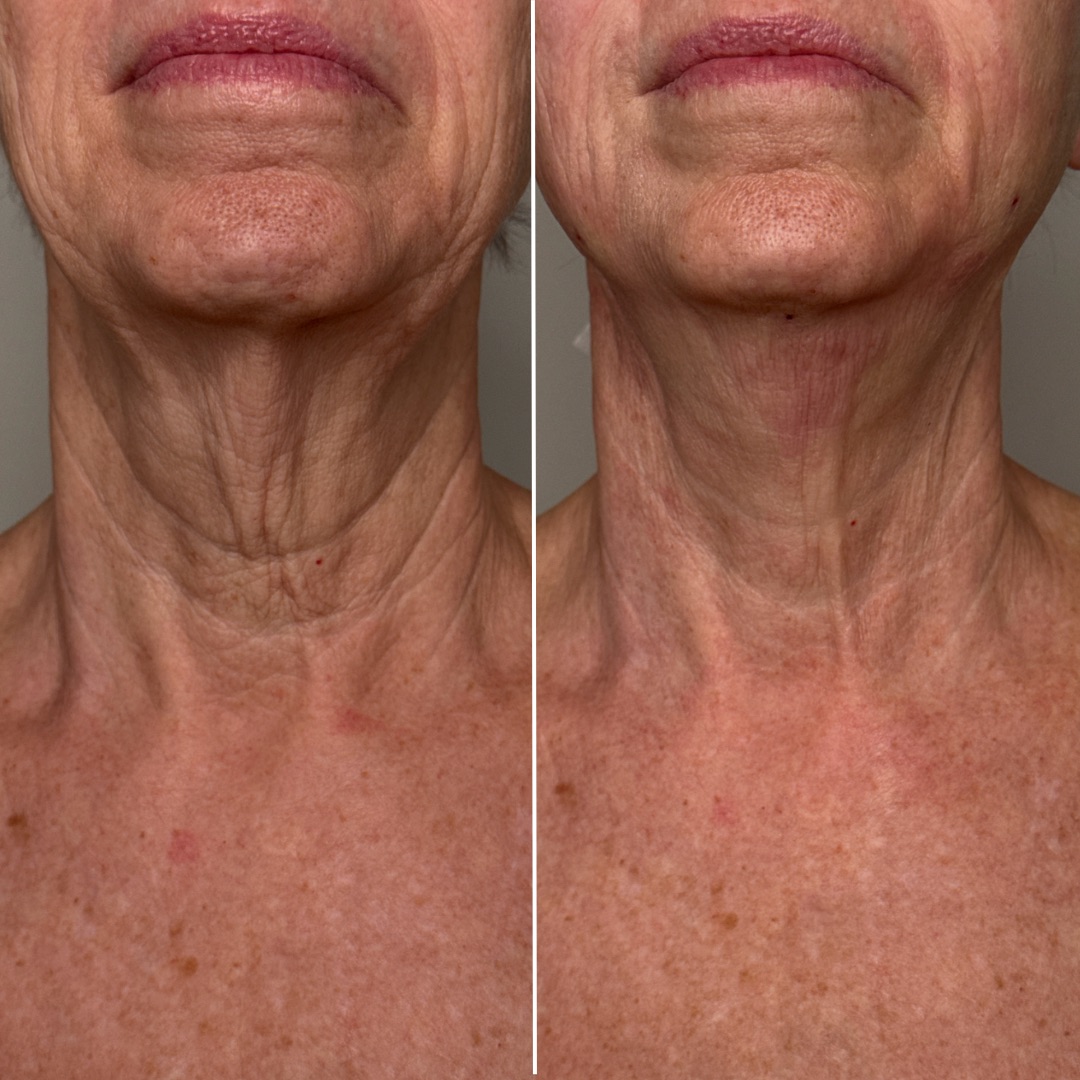 Non-Surgical Neck Lift Transformation at Refine by Tulsi using ILaser