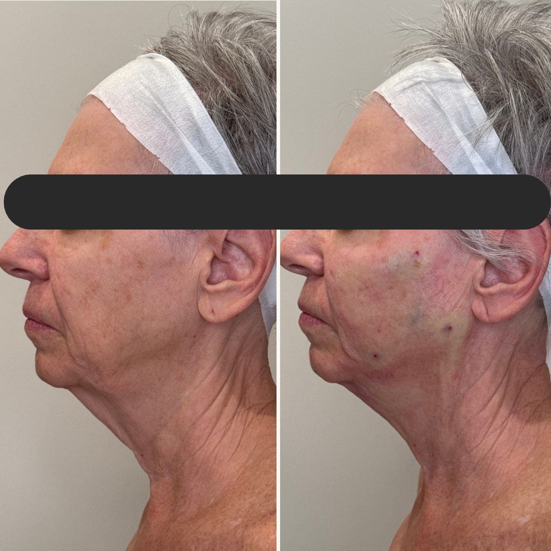 Beige Minimalist Skincare Before and After Instagram Post - 3