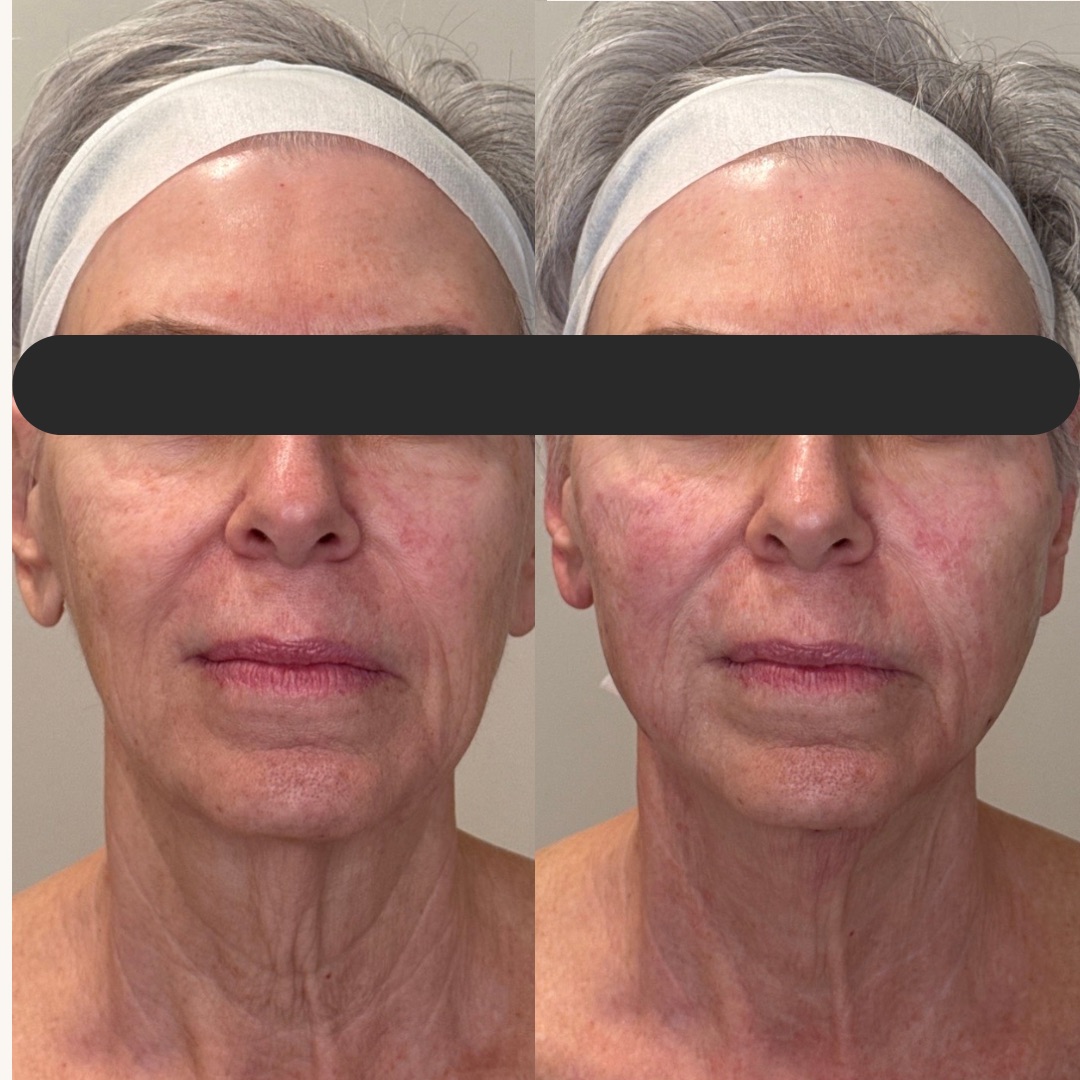 Beige Minimalist Skincare Before and After Instagram Post - 5