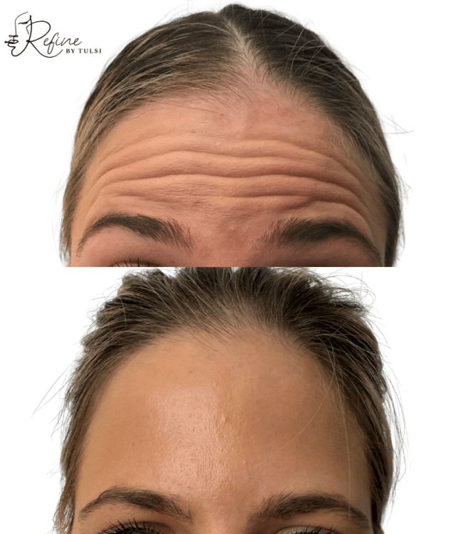 Patient 1 Botox Before and After | Refine By Tulsi