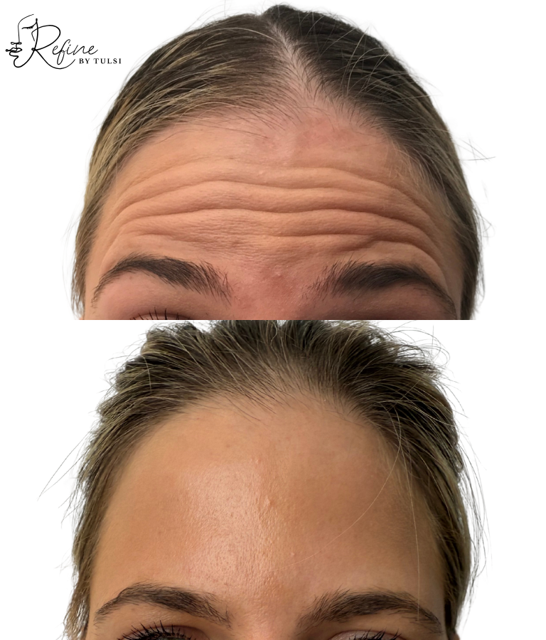 Dramatic improvement in forehead lines, achieving a smooth and youthful appearance