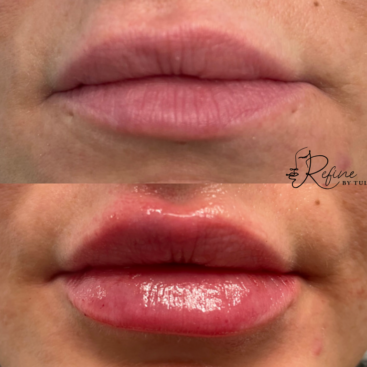 Patient 27 Lip Filler Before and After at Refine by Tulsi Med Spa in Chicago IL