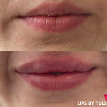 Patient 28 Lip Filler Before and After at Refine by Tulsi Med Spa in Chicago IL