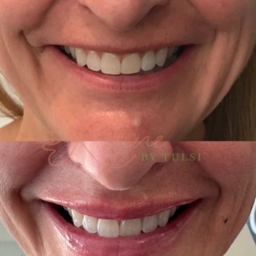 Patient 29 Lip Filler Before and After at Refine by Tulsi Med Spa in Chicago IL