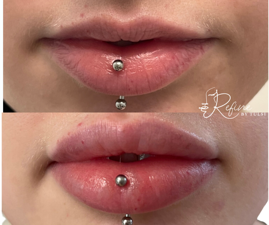 Patient 30 Lip Filler Before and After at Refine by Tulsi Med Spa in Chicago IL