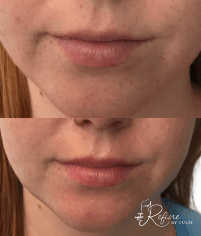 Patient 33 Lip Flip with Botox Before and After