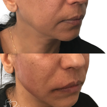 Patient 34 PDO Threads Partial Face Lift Before and After at Refine by Tulsi Medspa in Chicago IL