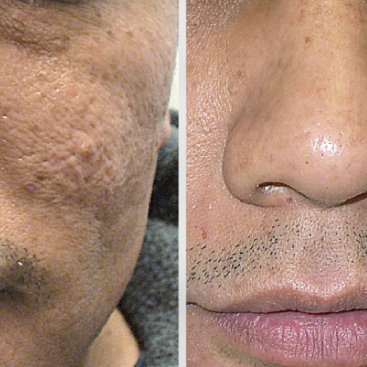 Patient 35 Microneedling for Acne Treatment Before and Afterr at Refine by Tulsi Med Spa in Chicago IL