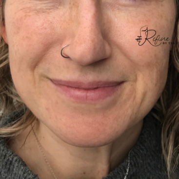 Patient 38 Liquid Nose Job with Dermal Fillers Before Treatment at Refine by Tulsi Medspa in Chicago IL