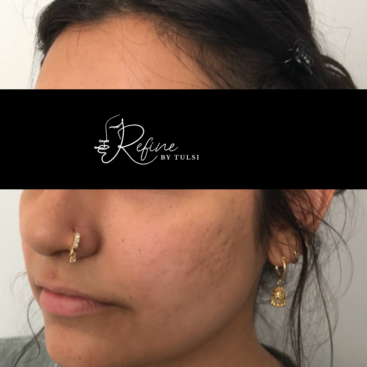 Patient 39 Cheeks with Dermal Fillers Before treatment at Refine by Tulsi Med Spa in Chicago IL