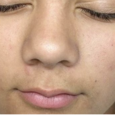 Patient 40 Chemical Peel for Acne After