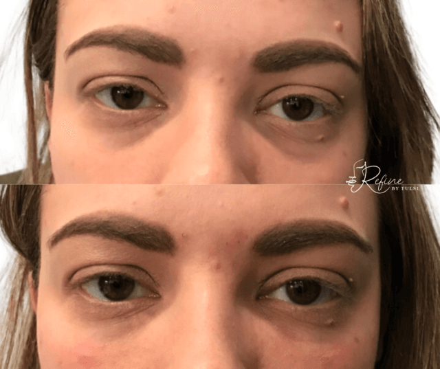 Patient 43 Under Eye Filler Before and After at Refine by Tulsi Med Spa in Chicago IL