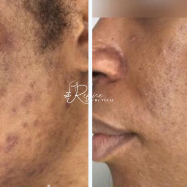 Dark Skin Tone Acne Treatment Before and After at Refine by Tulsi Med Spa in Chicago IL