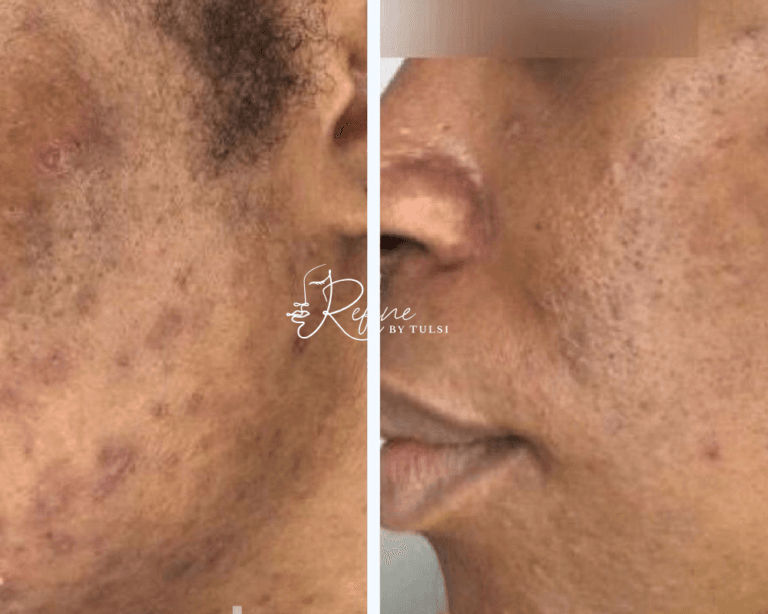 A closer look at Acne On Patients Legs Treatment