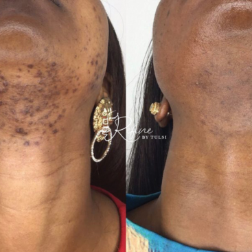 Dark Skin Tone Acne Treatment Before and After at Refine by Tulsi Med Spa in Chicago IL