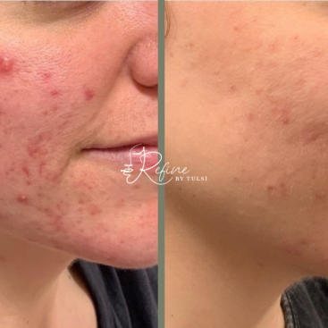 Patient 46 Acne Treatment Before and After at Refine by Tulsi Med Spa in Chicago IL