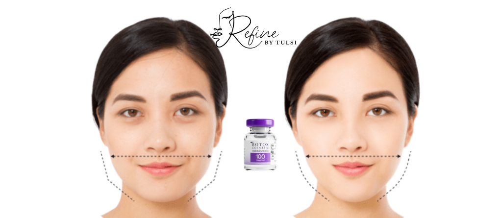 Masseter Botox treatment at Refine by Tulsi Med Spa in Chicago leads to jaw slimming