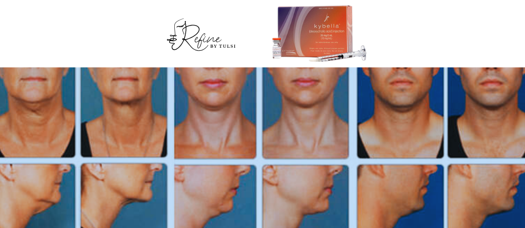 Kybella for Double Chin treatment at Refine by Tulsi Med Spa