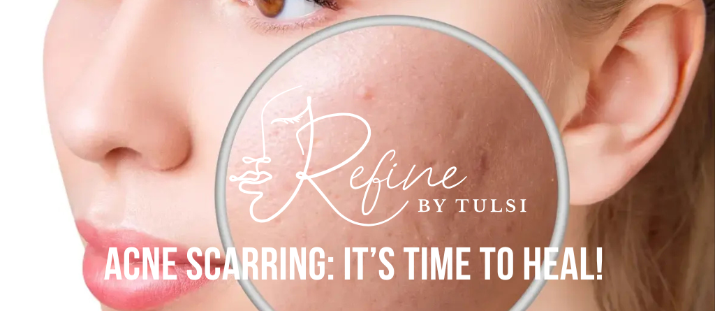 Medical Acne Scarring Treatment at Refine by Tulsi