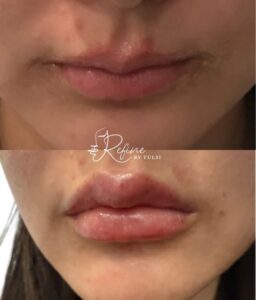 1ML Lip Filler for Thin Lips Lip Filler | Refine By Tulsi Med Spa 1ml lip filler before and after results using Restylane Kysse at Refine by Tulsi, showing enhanced lip volume and improved lip shape.