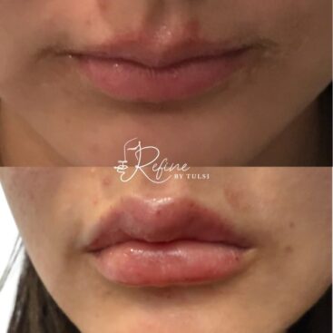 1ml lip filler before and after results using Restylane Kysse at Refine by Tulsi, showing enhanced lip volume and improved lip shape.