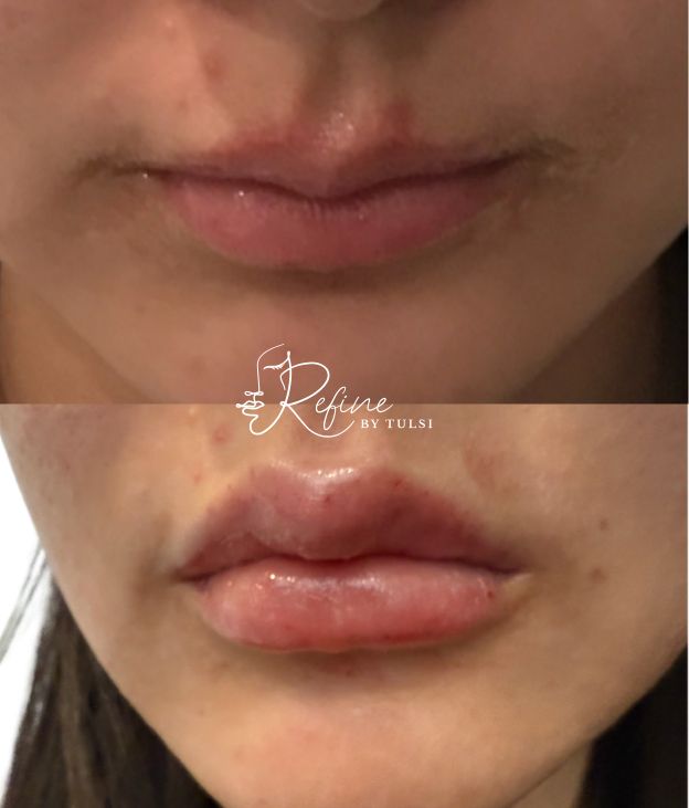 1ML Lip Filler for Thin Lips Lip Filler | Refine By Tulsi Med Spa 1ml lip filler before and after results using Restylane Kysse at Refine by Tulsi, showing enhanced lip volume and improved lip shape.