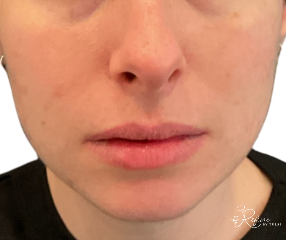 After acne treatment with Aerolase Neo Laser and chemical peels, showing clear, smooth, and even-toned skin.