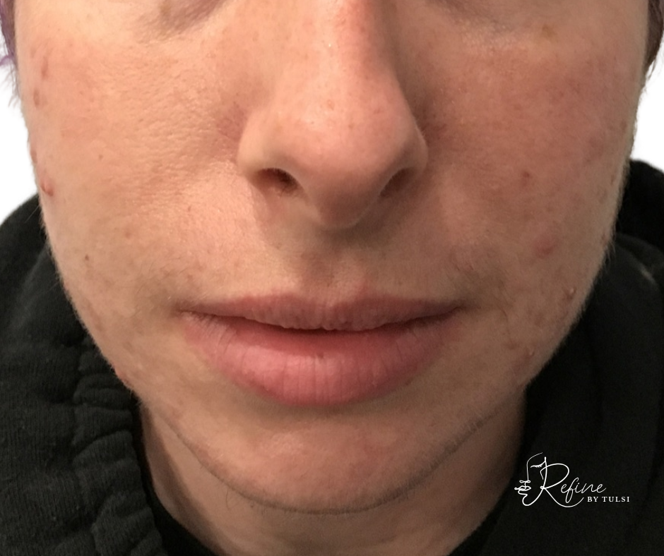 Before acne treatment showing active breakouts, redness, and uneven skin texture.