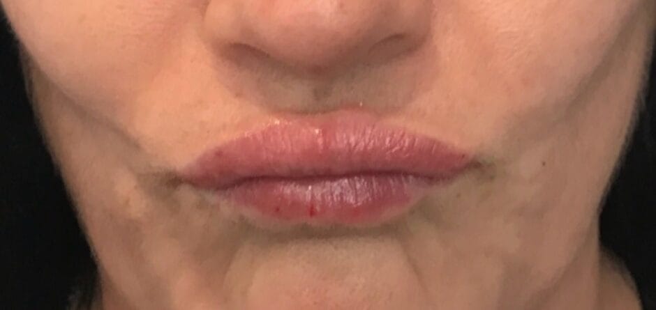 After image showing reduced barcode lines around the lips following dermal filler treatment.