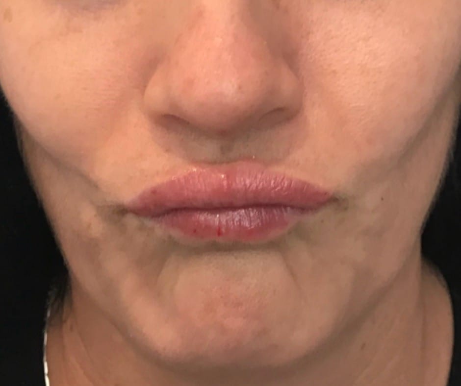 After image showing reduced barcode lines around the lips following dermal filler treatment.
