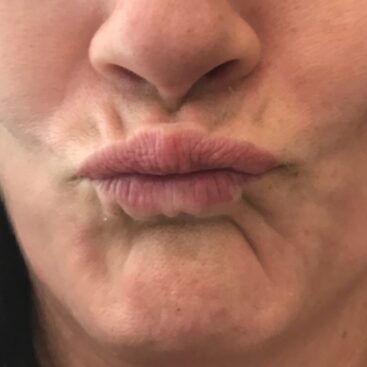 Before image of barcode lines around the lips for dermal filler treatment.