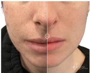 Screenshot | Refine By Tulsi Med Spa Incredible Acne Transformation Before and After at Refine by Tulsi