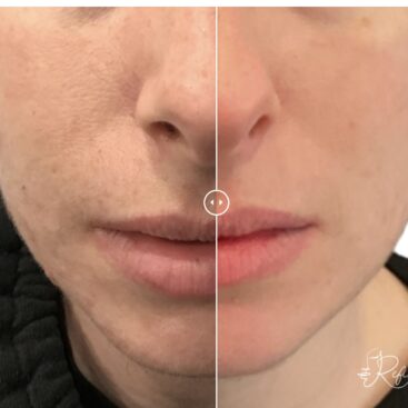 Incredible Acne Transformation Before and After at Refine by Tulsi