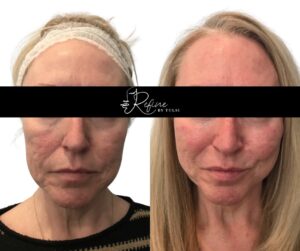 PDO Threads Mid and Lower Face Lift Before and After | Refine By Tulsi Med Spa Before and after PDO thread lift demonstrating tightened and lifted mid and lower facial skin.