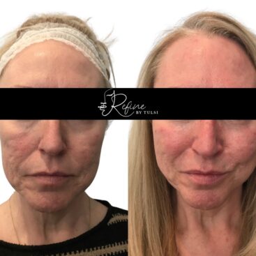 Before and after PDO thread lift demonstrating tightened and lifted mid and lower facial skin.