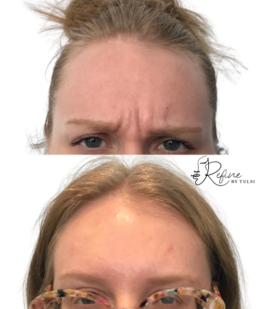 Patient 52 Daxxify Before and After 11s | Refine By Tulsi Med Spa Patient 11 frown lines before and after Daxxify treatment showing smoother, relaxed brow area.