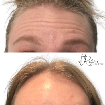 Patient forehead wrinkles before and after Daxxify treatment at Refine by Tulsi Med Spa.