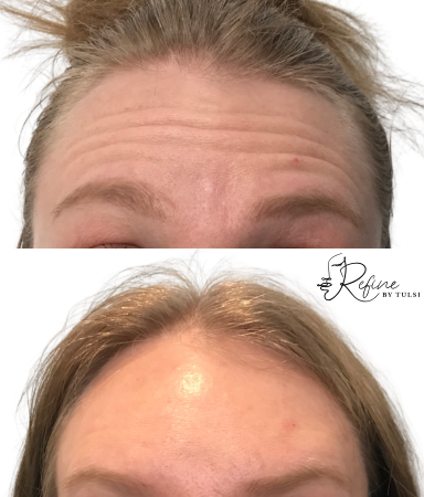 Patient 52 Daxxify Before and After Forehead Wrinkles | Refine By Tulsi Med Spa Patient forehead wrinkles before and after Daxxify treatment at Refine by Tulsi Med Spa.