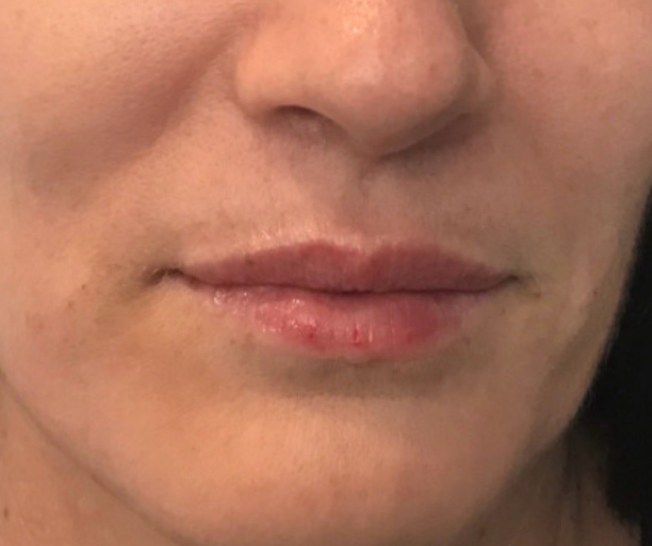 After subtle half syringe lip filler showing enhanced lip volume and definition.