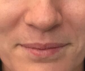 Before Half of syringe lip filler | Refine By Tulsi Med Spa Before half of syringe lip filler