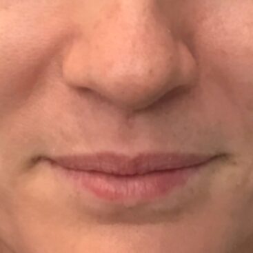 Before half of syringe lip filler