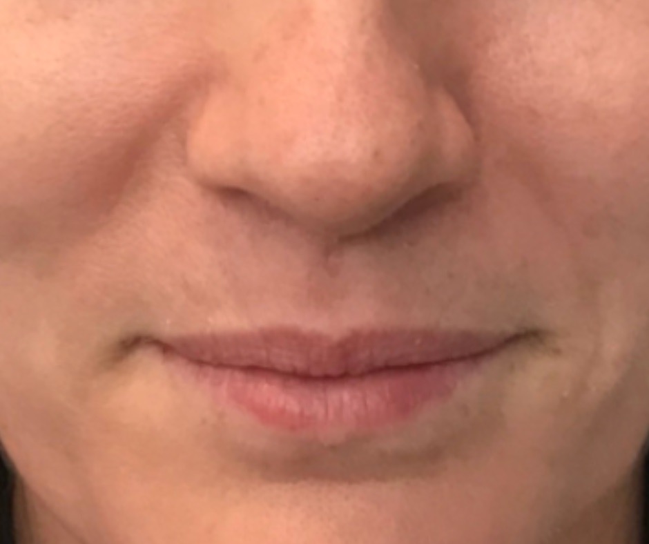 Before half of syringe lip filler