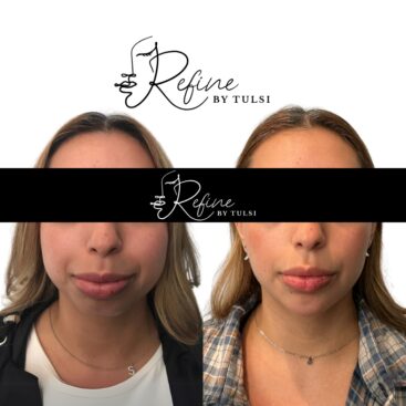 Chin Filler Before and After at Refine by Tulsi