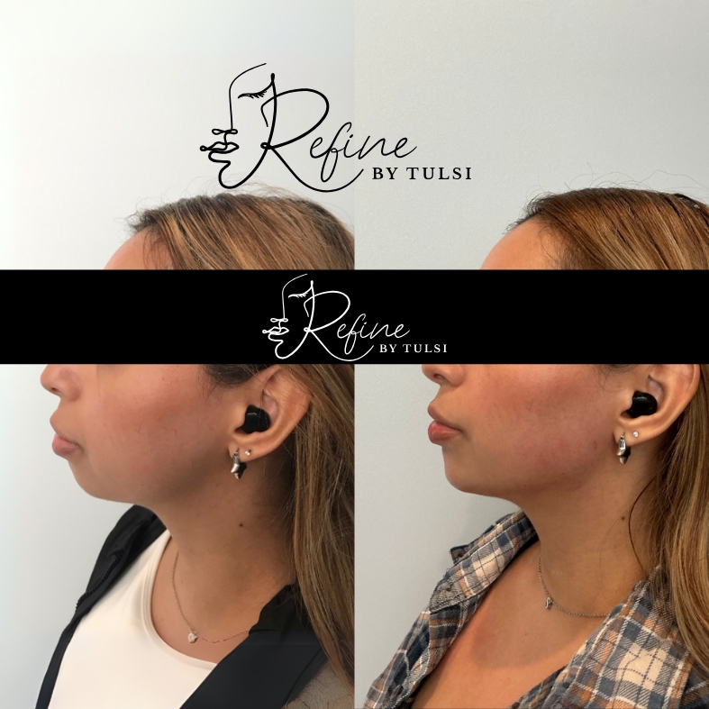 Jaw Line Filler Before and After at Refine by Tulsi