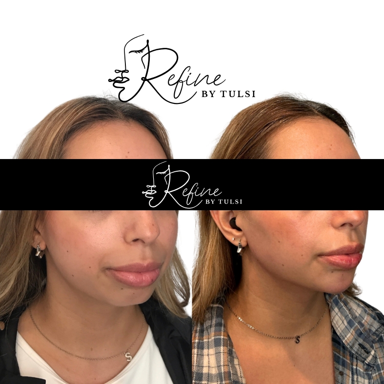 Masseter Botox Before and After at Refine by Tulsi