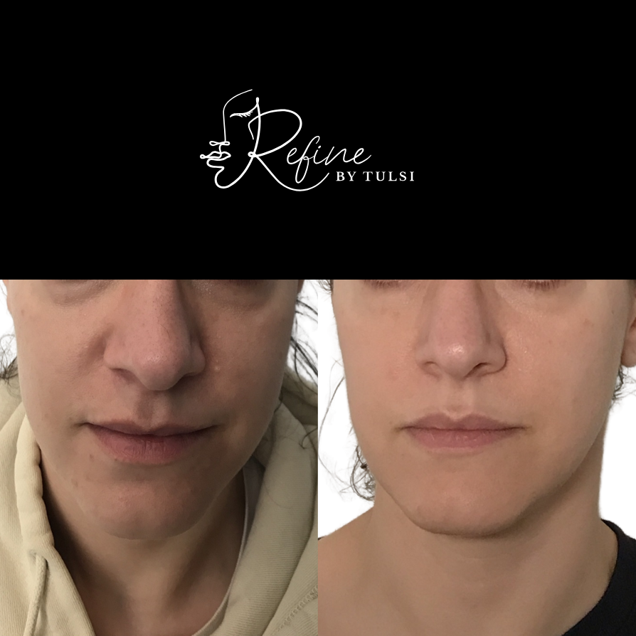 Sculptra Before and After at Refine by Tulsi