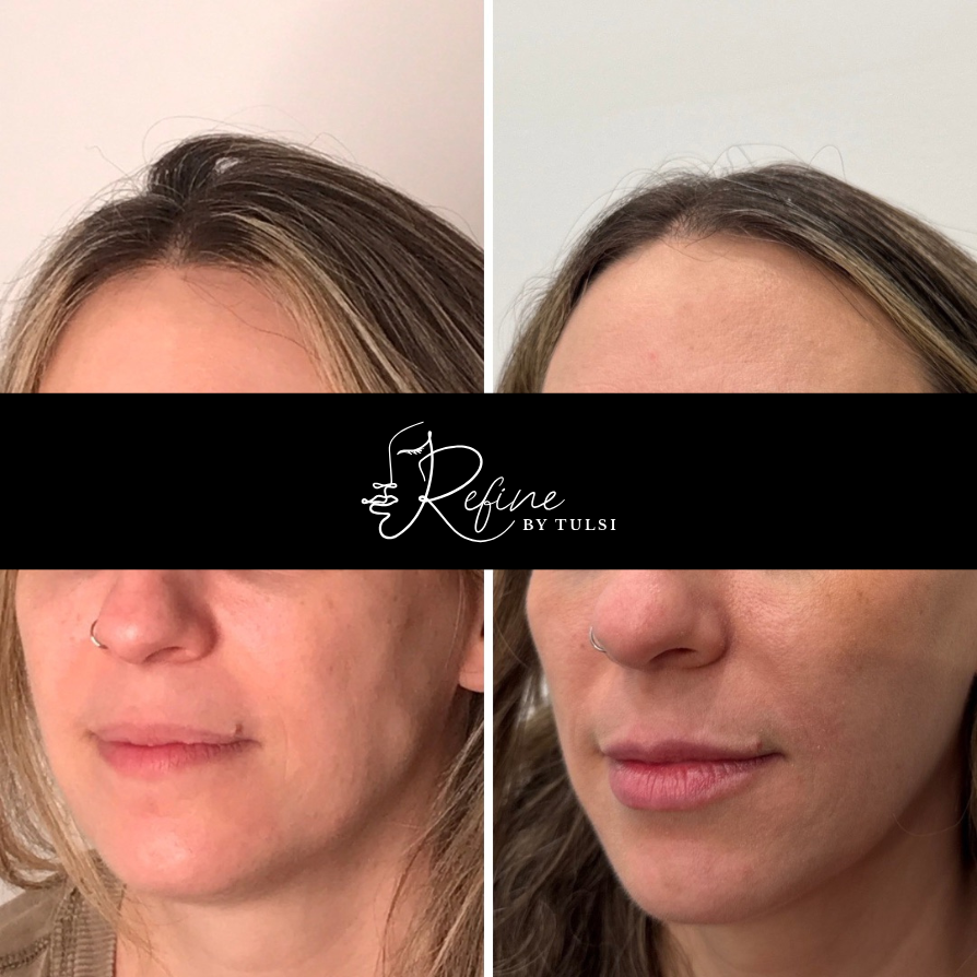 Facial Balancing Before After