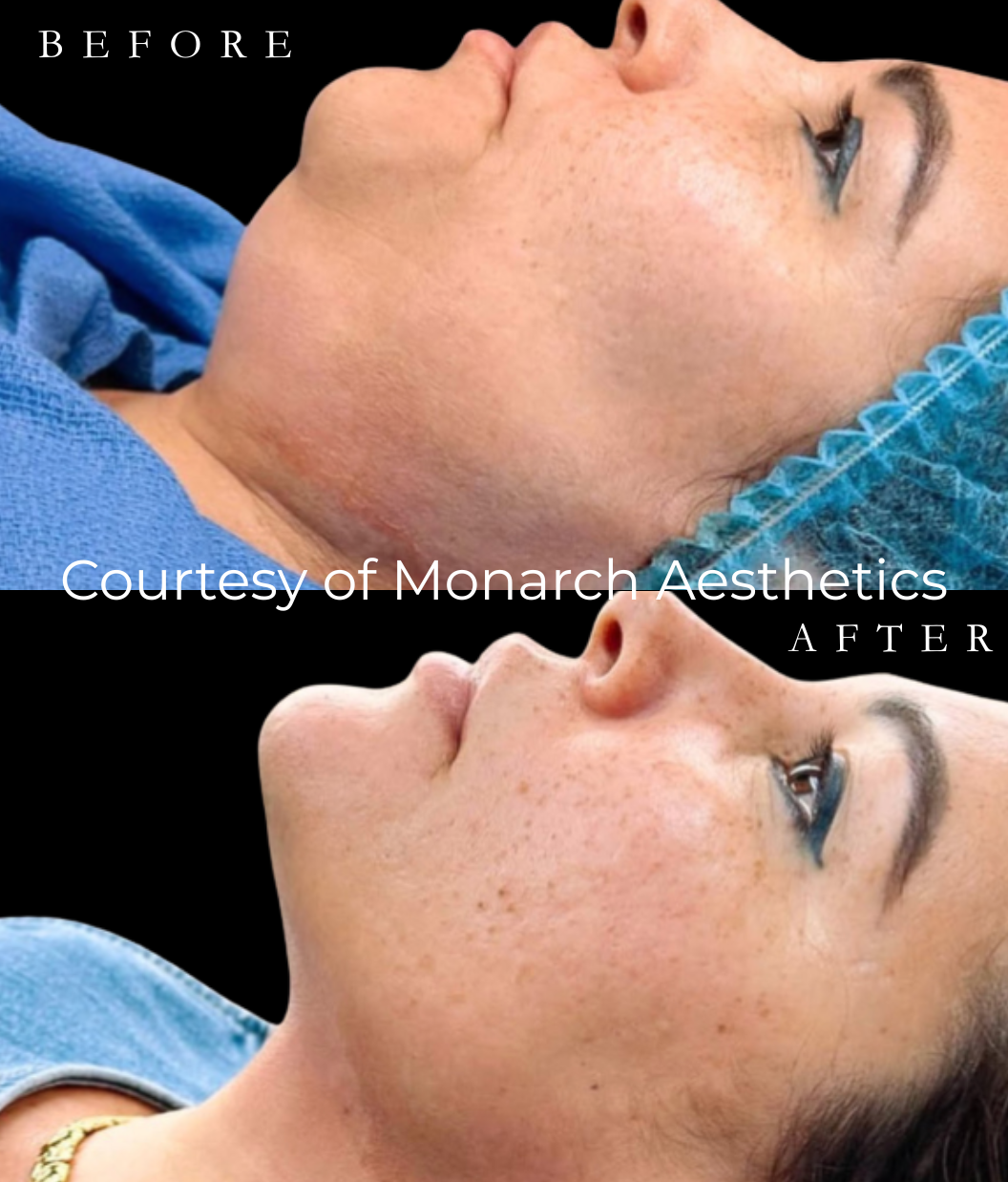 Before & After - Vertical